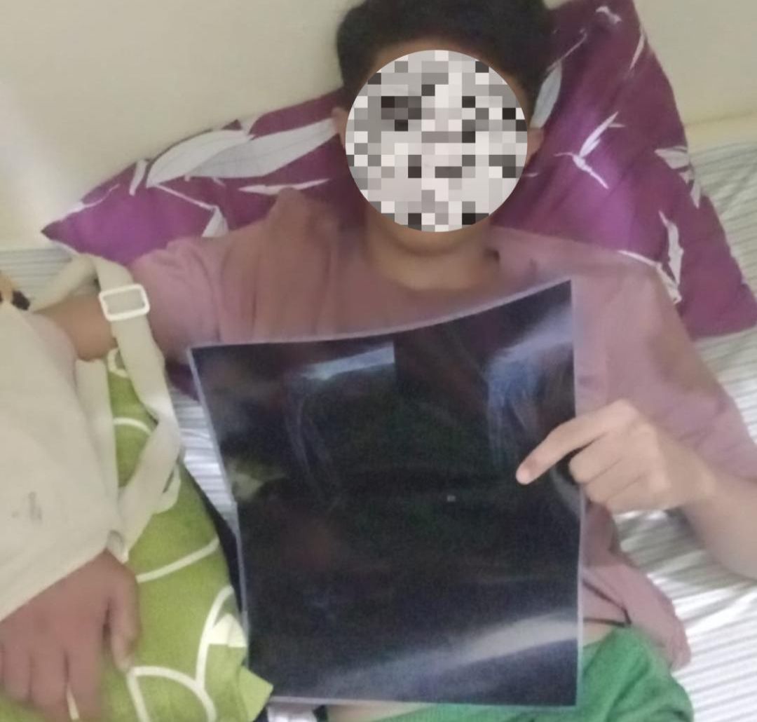 Dikeroyok OTK di Pontianak Timur, Remaja 15 Tahun Alami Patah Tangan: Keluarga Desak Polresta Tangkap Pelaku
